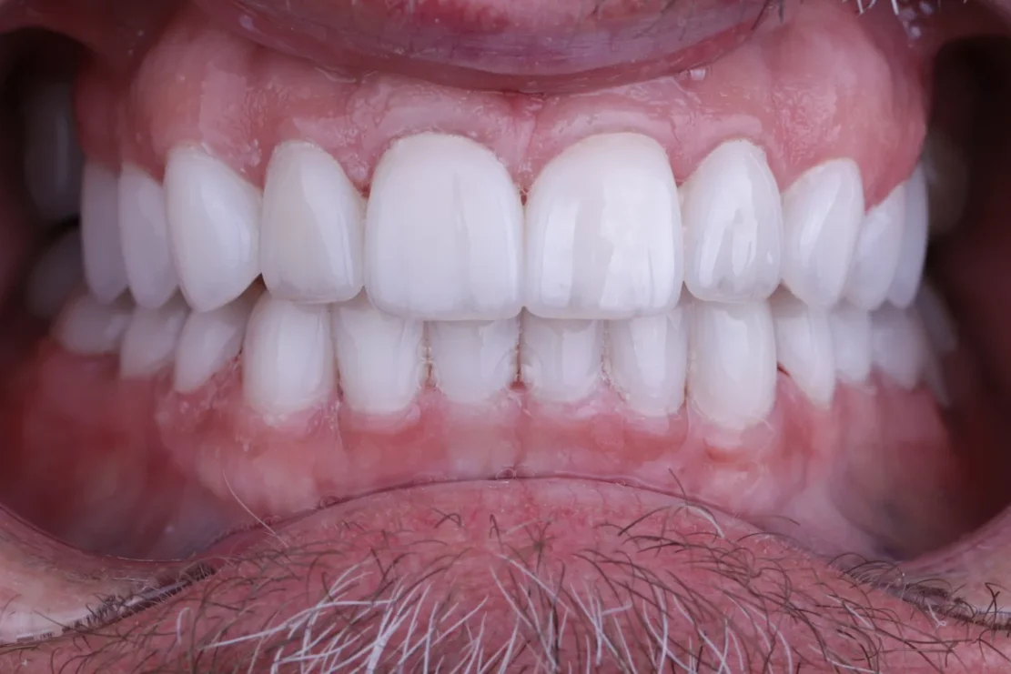 Hollywood Smile: Custom veneers