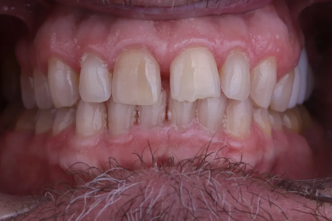 Hollywood Smile: Custom veneers